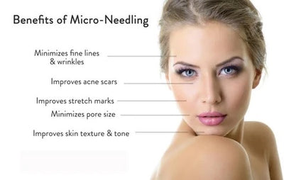 Microneedling Pkg of 3 |  | SoElla • Salon • Laser | Kelowna Skin Laser Aesthetics